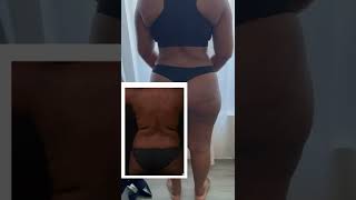 4 months results after liposuction 360 and tummy tuck