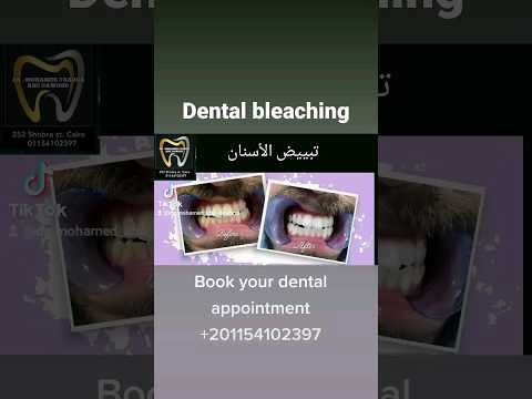 تبييض الأسنان لا ينصح بتكراره الا على فترات متباعده عند الضرورة