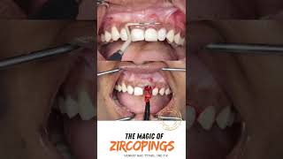Immediate Implant for Failed RCT &amp; Deep Bite | Best Dental Hospital in Hyderabad