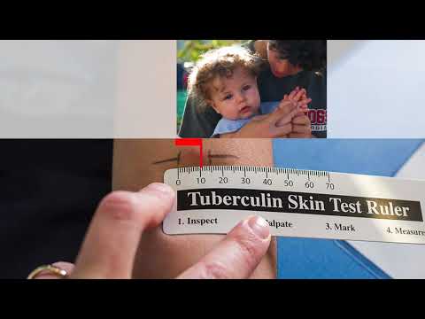 Video: Når tuberkulin hudtest?