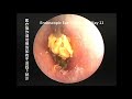 Cerumen embolism caused by cotton swabs