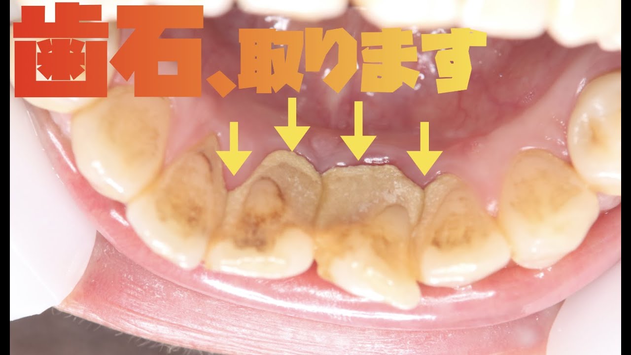 取れると気持ちいい歯石除去　ほぼノーカットでご覧ください