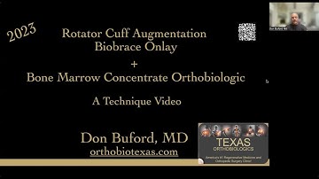 Technique Video: Rotator Cuff Repair with Biobrace and Bone Marrow Concentrate.  Don Buford, MD