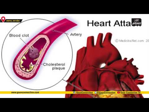 employment news tamilnadu Prof. V.S.Narayan | Here's how you can prevent heart failure | KGMU