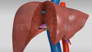 Liver transplant: Living donor right hepatectomy (donor procedure)