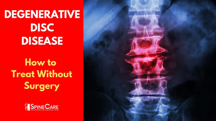 What is DEGENERATIVE DISC DISEASE? | How to Treat It WITHOUT SURGERY - DayDayNews