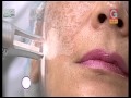 Tratamiento de manchas faciales con láser