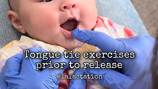Infant tongue exercises prior to tongue and lip tie release
