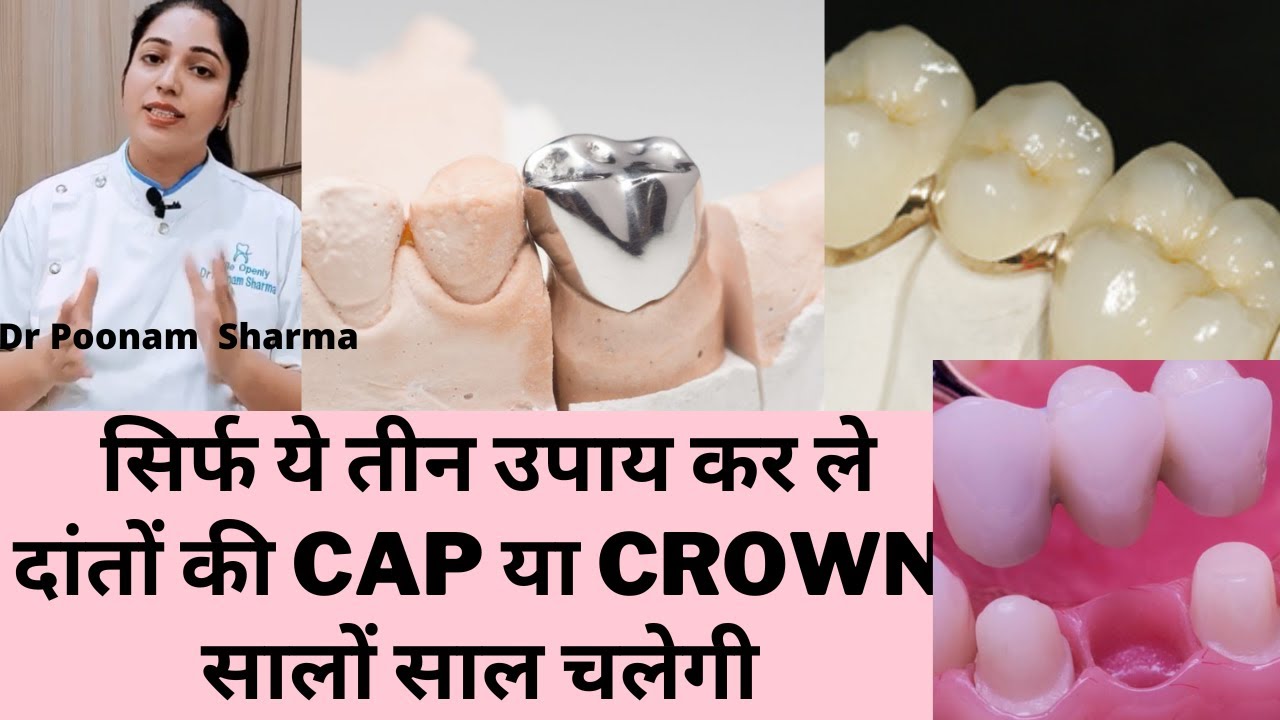 दांतो की कैप को  चलाना है सालो साल तो करे यह उपाय | Cap Ya Crown Kabhi Nhi Niklenge Kare Yah Upay