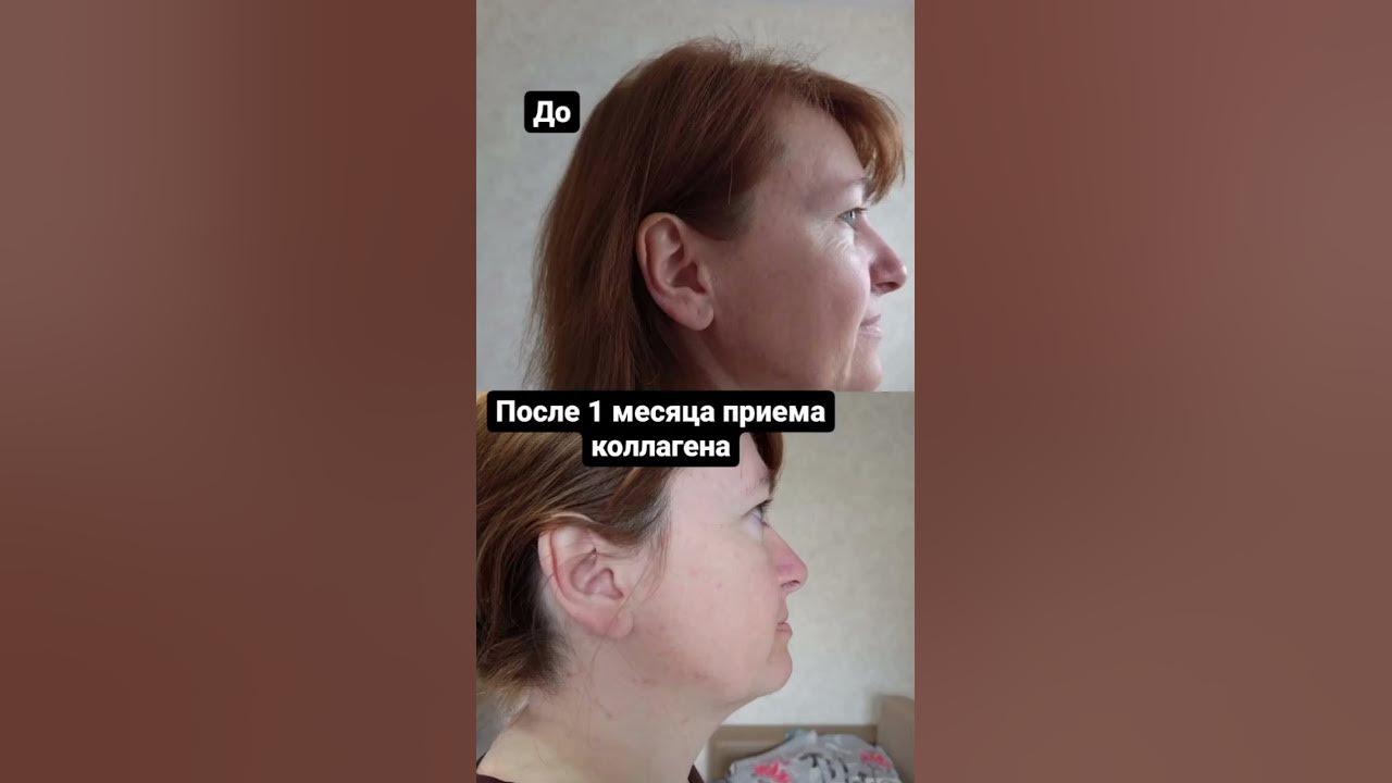 Коллаген нл отзывы фото до и после