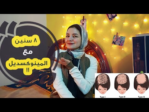 تجربتى مع المينوكسديل لمدة ٨ سنين فى علاج تساقط الشعر ايه هى عيوب المينوكسديل