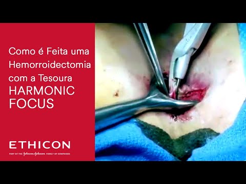 Vídeo: Hemorróidas 2 Graus: Tratamento Sem Cirurgia, Sintomas, Fotos, Conselho Médico