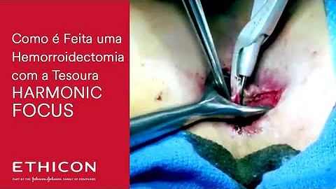Como é feita a operação de hemorróidas?