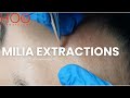 Milia extractions part two   milia medley