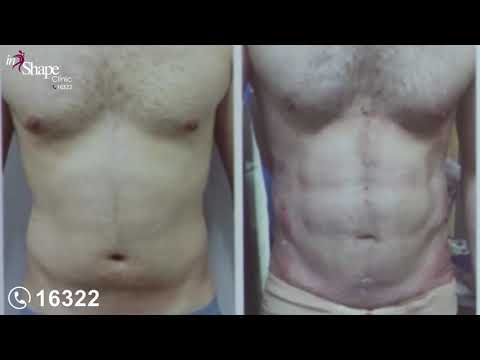 نحت عضلات البطن مع الدكتور هاني نبيل