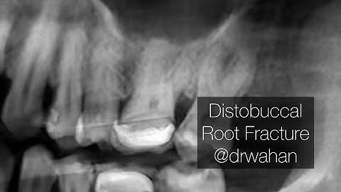Root Fracture and Retrieval from Maxillary Molar Extraction