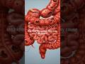 Your gut’s hidden danger in 60 seconds. #Diverticulitis #GutHealth #MedicalAI #AIExplains #AIVideo