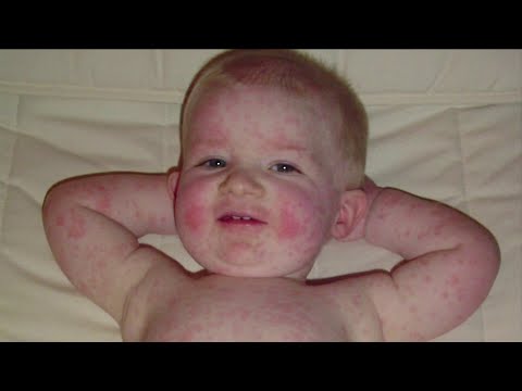 Video: Gør femtedels sygdomsudslæt ondt?