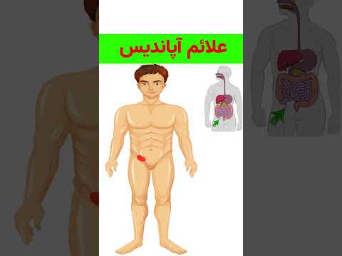 تصویری: نحوه تشخیص علائم آپاندیسیت: 15 مرحله