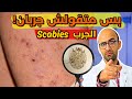 Scabies الجرب مش عيب اسباب الجرب وعلاجه 