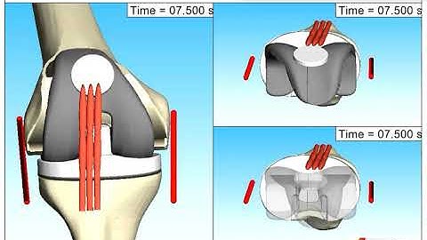 Knee joint kinematics during flexion-extension have been analyzed via Multibody Simulation (SIMPACK)