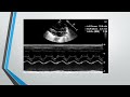 Echocardiography in PDA
