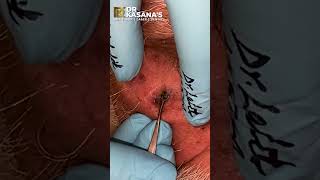 Deep Blackheads Removal from - Nose