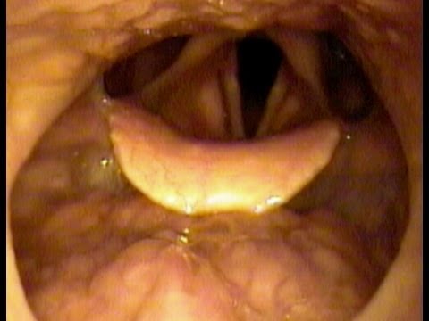 "Where" Snoring Comes From (Sleep Endoscopy)