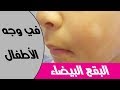5 اسباب لظهور البقع البيضاء في الوجه عند الاطفال