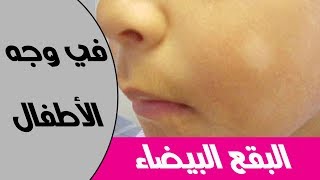5 اسباب لظهور البقع البيضاء في الوجه عند الاطفال