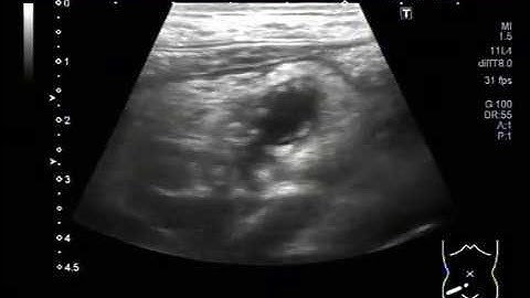 Ultrasound Video showing focusing of Inflamed Appendix