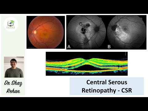 CSR - Central Serous Retinopathy: Signs, Symptoms, Diagnosis & Management I Dr Shaz Rehan, 2021