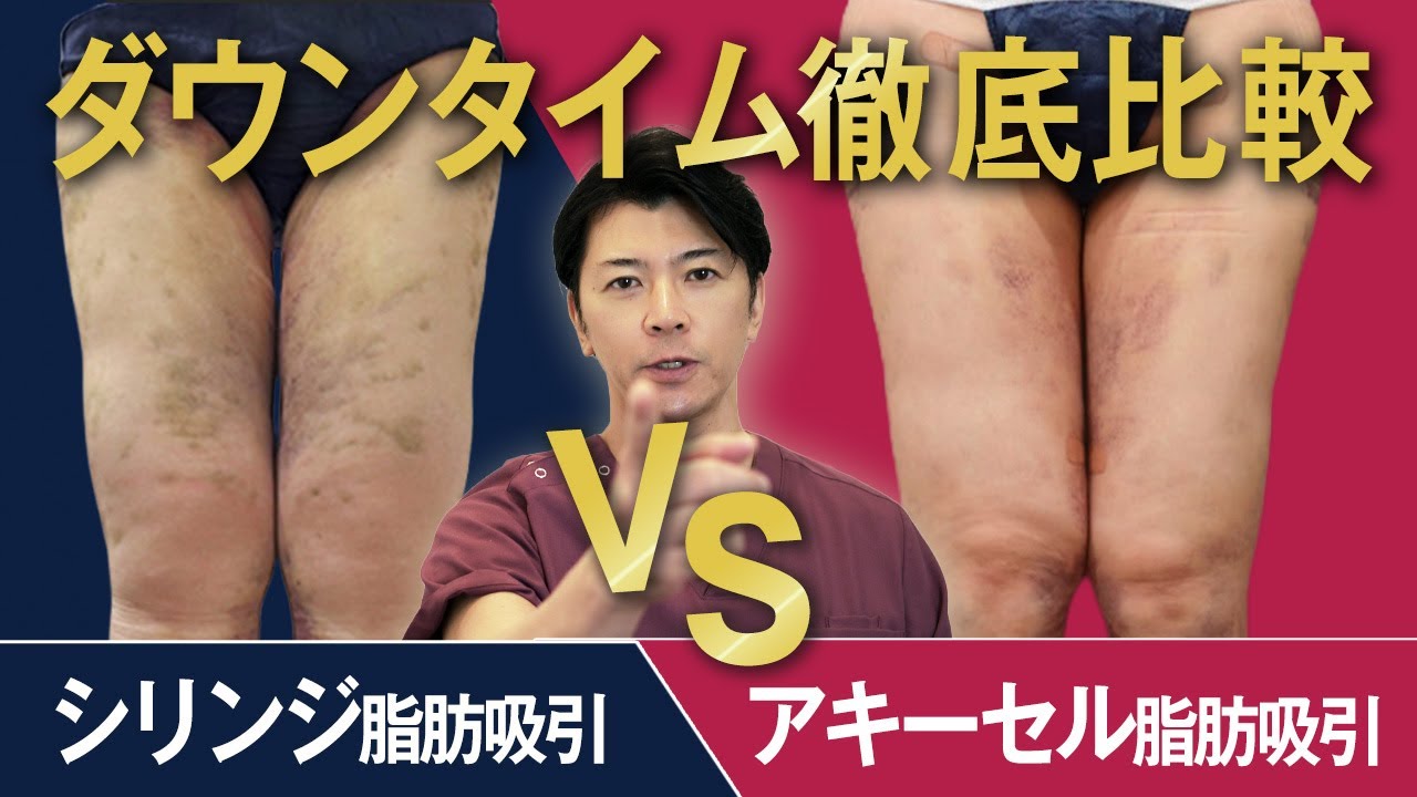 Case Comparison] How much does downtime after liposuction vary