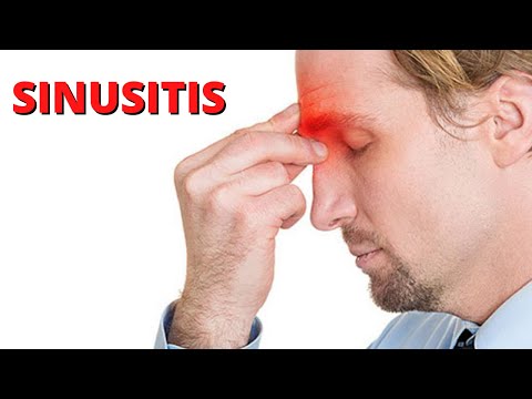 Vídeo: Sinusitis Frontal: Causas, Síntomas Y Diagnóstico