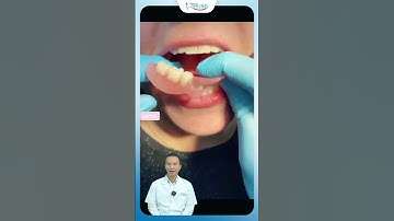 Quy Trình Lắp Răng Giả Tháo Lắp | Bác Sĩ Yên