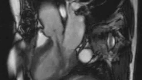 Austin Flint Murmur | NEJM