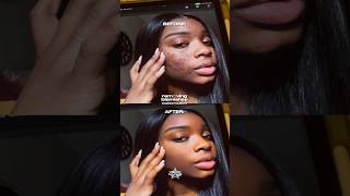 How To Remove Facial Blemishes ✨| Superimpose X App ✍🏽 #babykeledits