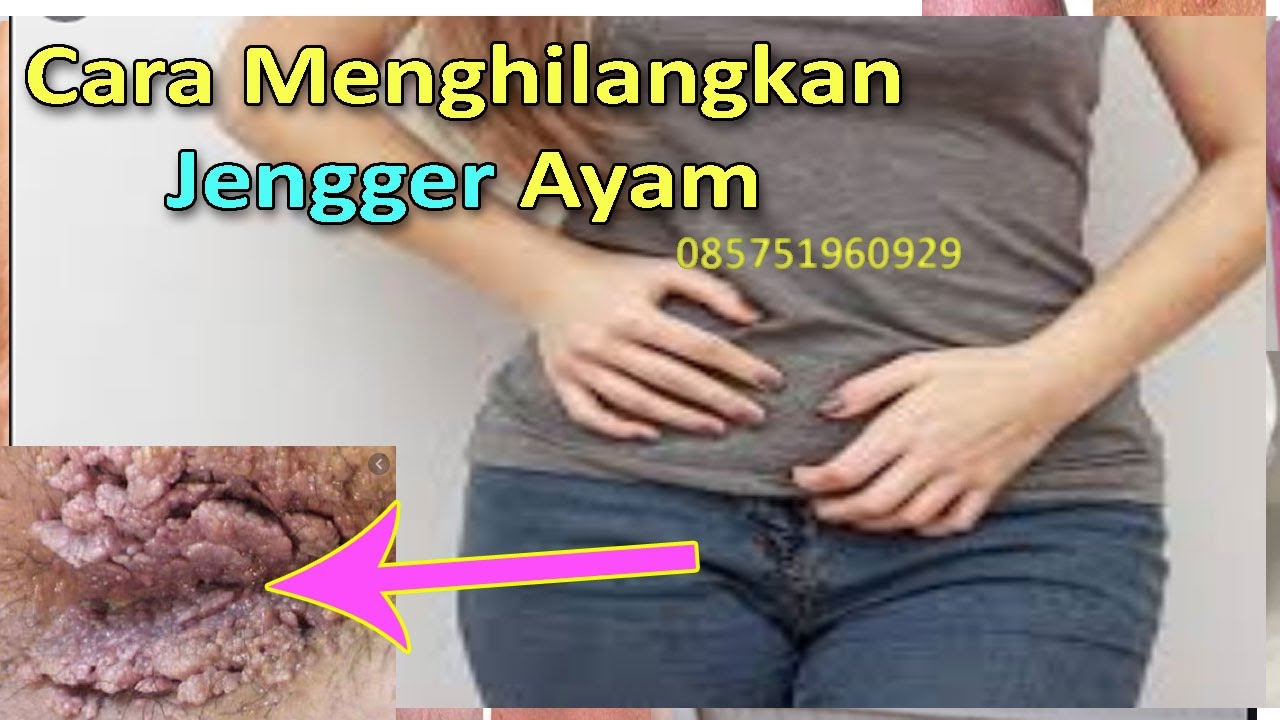 Cara Menghilangkan Jengger Ayam Pada Kelamin Wanita - Obat Kutil