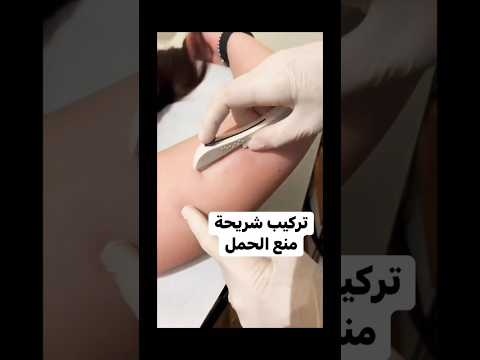 طريقة تركيب شريحة منع الحمل