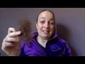 My Hair Loss Story: How To Cope Mentally With Alopecia Areata and Telogen Effluvium