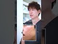 3回治療後の症例(20代男性)┃ニキビ跡治療