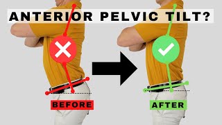 How to Fix Anterior Pelvic Tilt | Dr. Jon Saunders