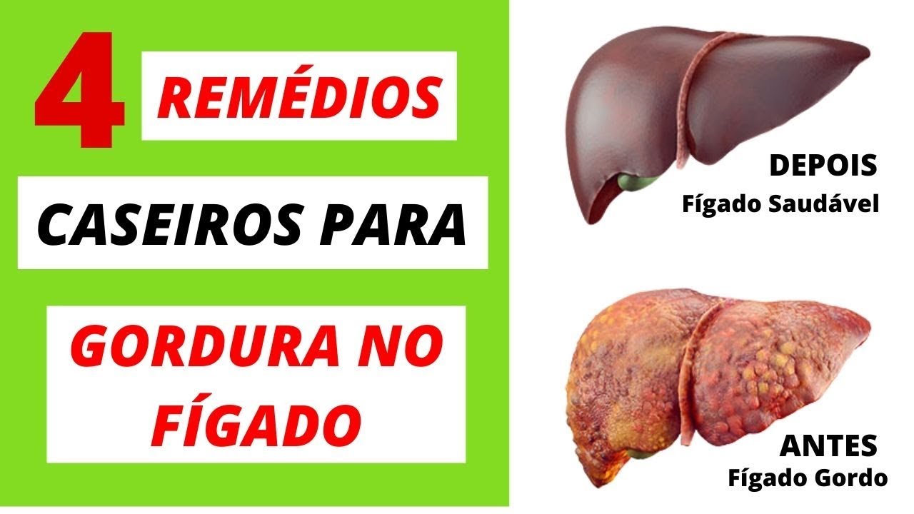 4 REMÉDIOS Caseiros Para GORDURA No FÍGADO. Como Tirar GORDURA Do ...