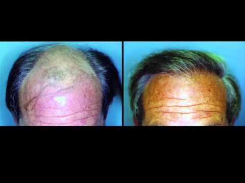 The Center for Hair Transplantation - Dr. Cohen