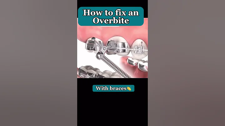 Overbite Correction #shorts