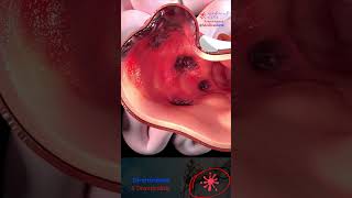 Diverticulosis, Diverticulitis And Diverticular Disease.