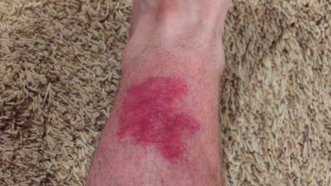 Wasp Sting! Ouch!