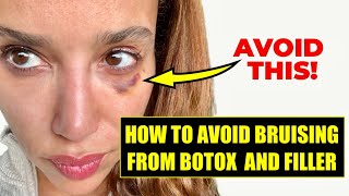 How to Prevent Bruising from Botox and Filler- DO THIS Before you get Facial Injections by Natural Injector - Emily Dowe, PA-C 10,866 views 9 months ago 7 minutes, 19 seconds