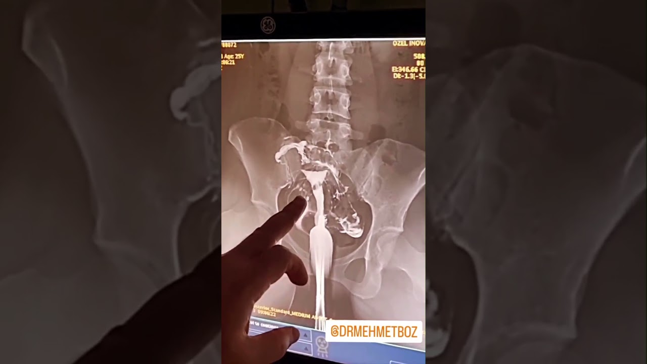 DR. MEHMET BOZ.  RAHIM FILMI.  HSG.  DOLUM DEFEKTI. İNFERTİLİTE.