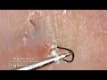 毛抜きneo［Ingrown hair］16